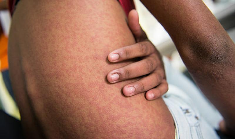 Cena de reportagem: france reports local chikungunya cluster CIDRAP, no trecho “Notificação da doença”